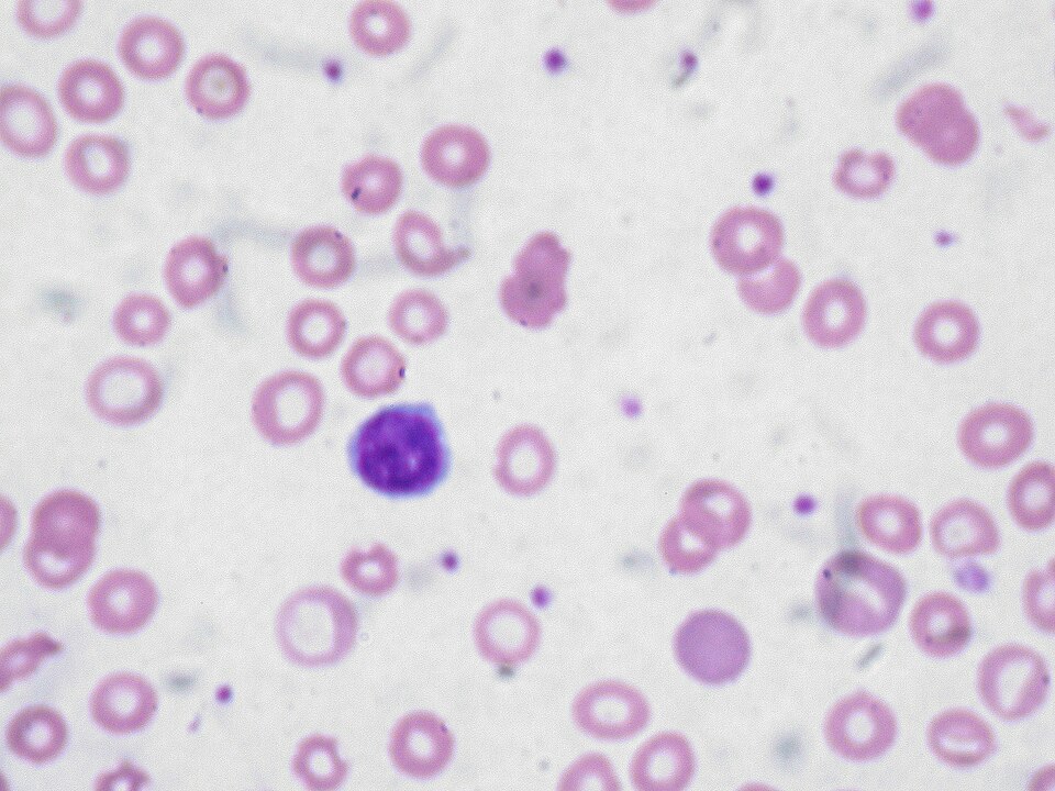Fayl:Iron deficiency anemia.jpg